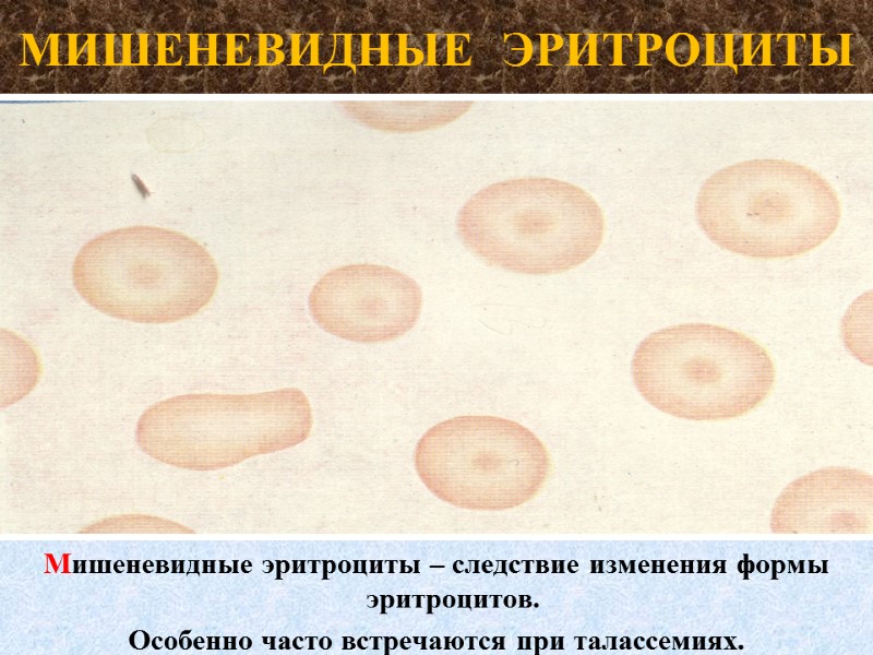 МИШЕНЕВИДНЫЕ  ЭРИТРОЦИТЫ Мишеневидные эритроциты – следствие изменения формы эритроцитов. Особенно часто встречаются при